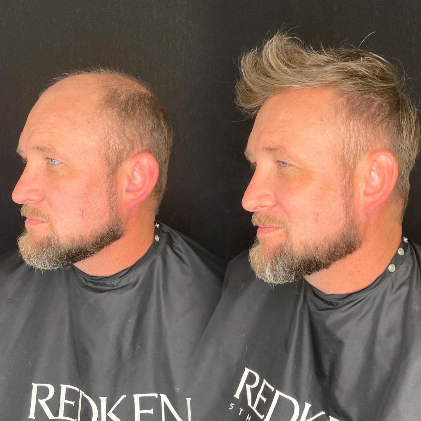 Before and after hair replacement for a man