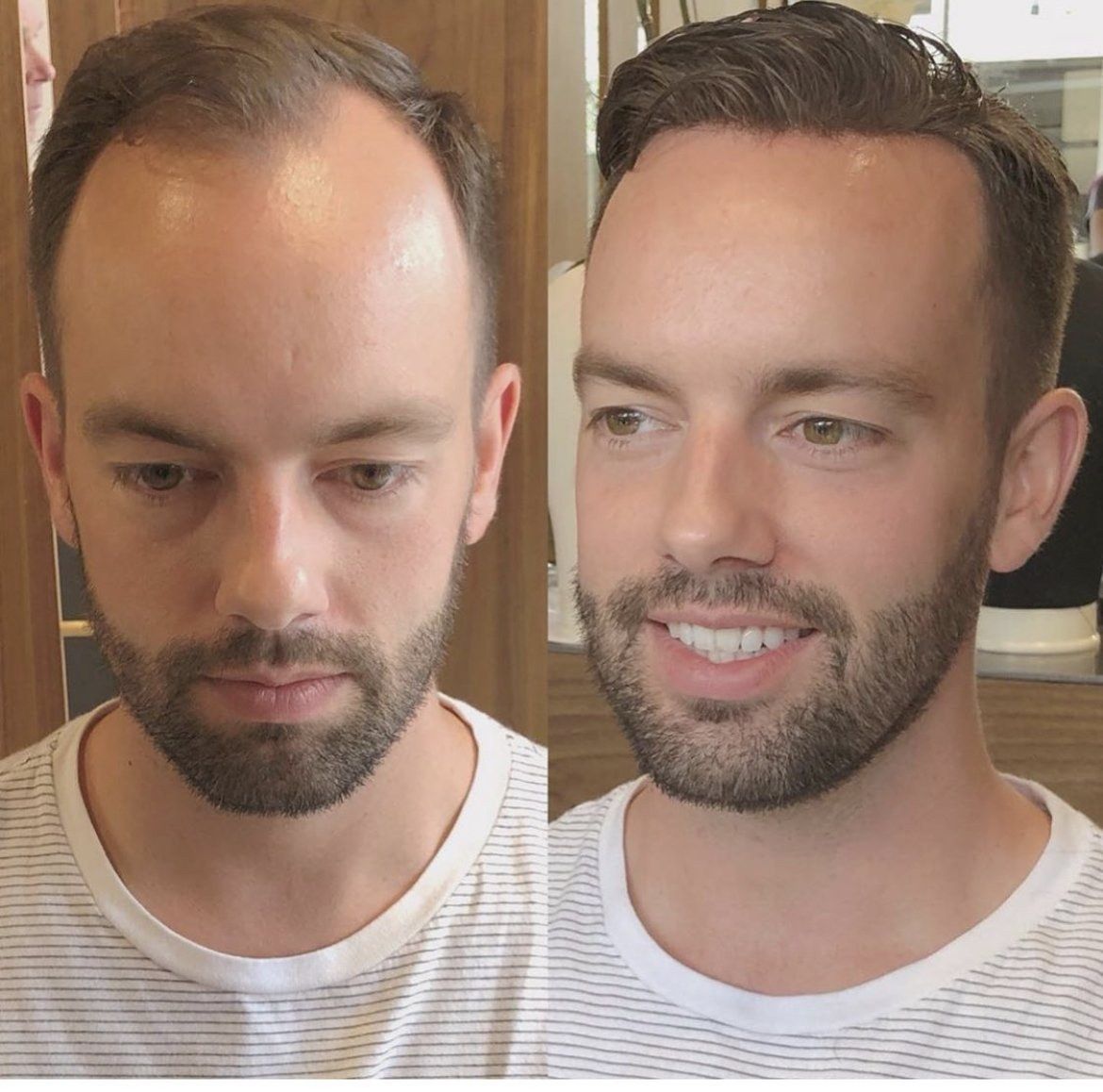 Before and after hair replacement for a man